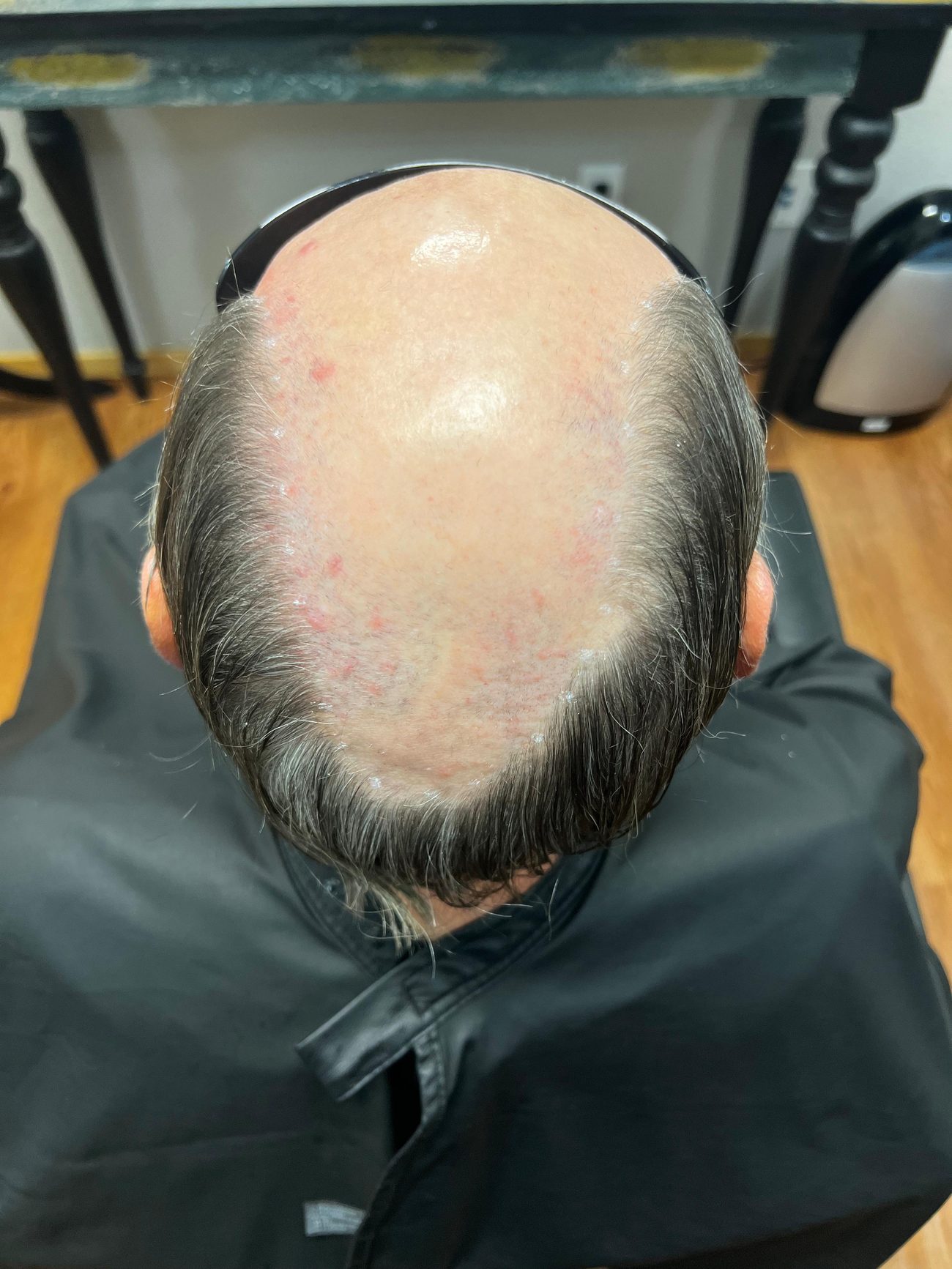 A man&rsquo;s exposed crown photographed from above before hair replacement