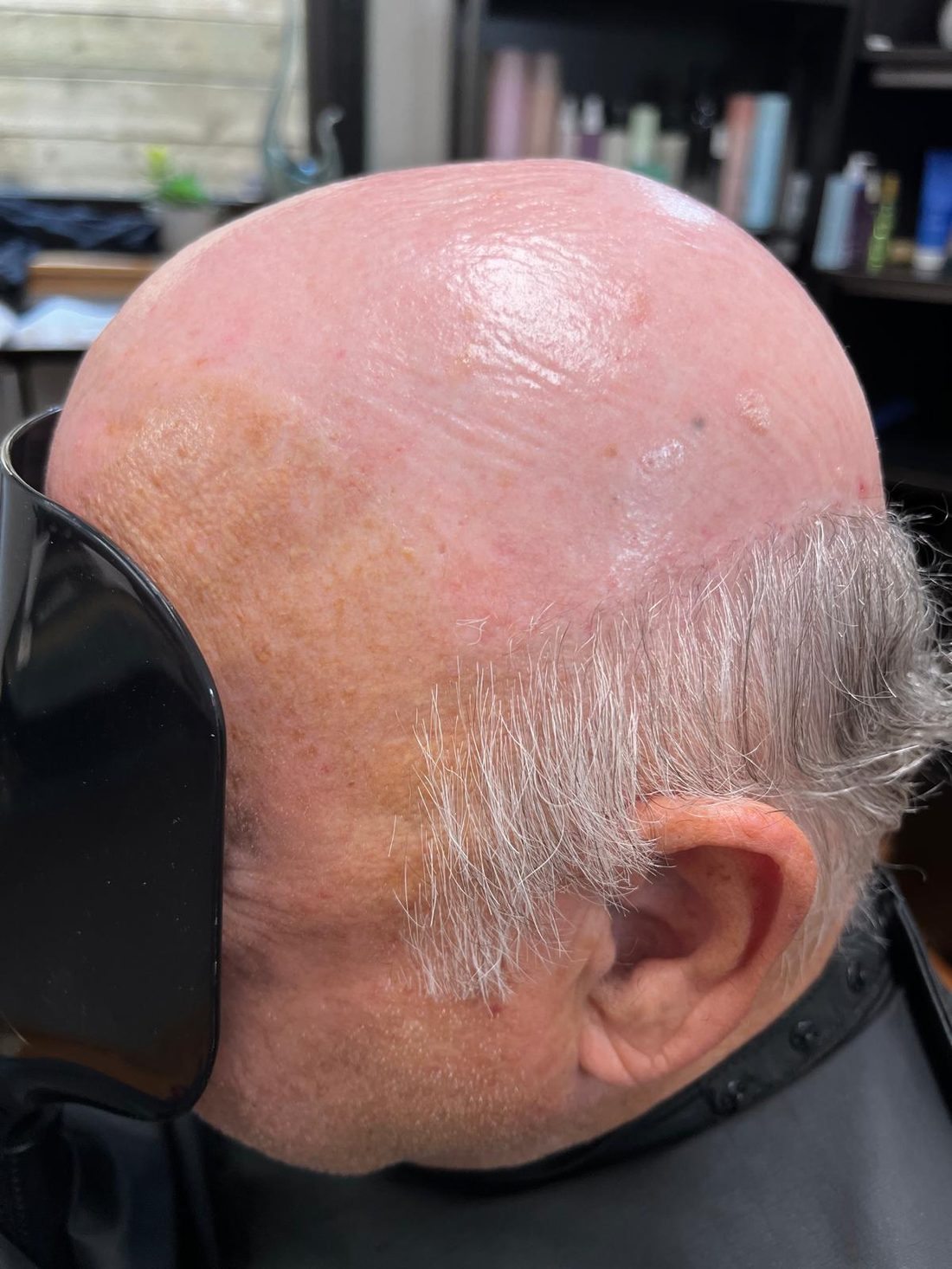 Side view of a man&rsquo;s fully exposed top and crown before hair replacement