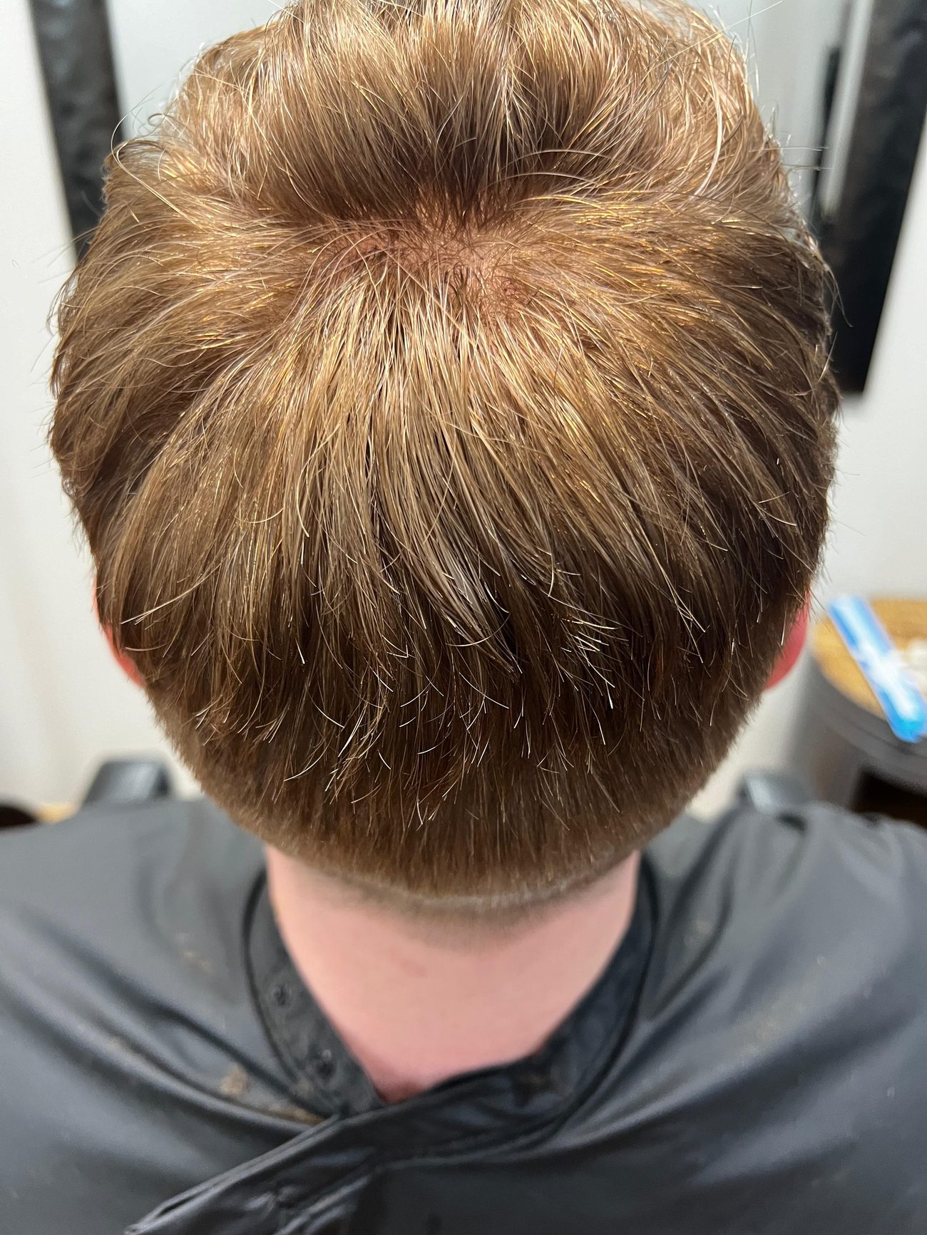 The same crown after a hair replacement system was fitted