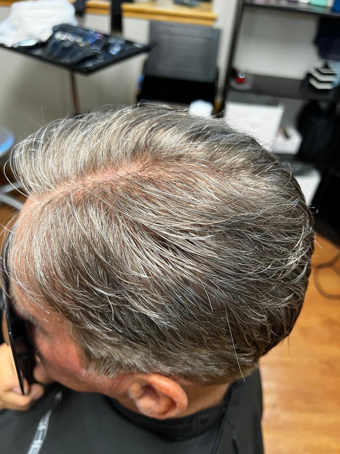 The same client from above after a hair replacement system was fitted and blended