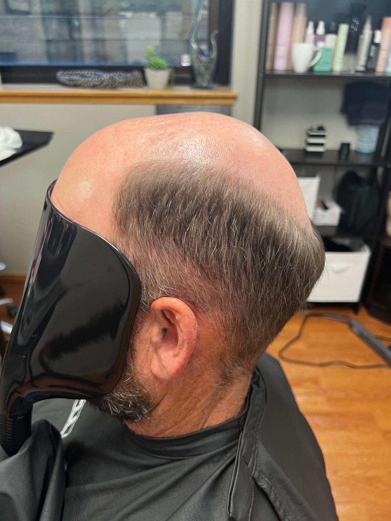 Side view of an exposed crown before hair replacement
