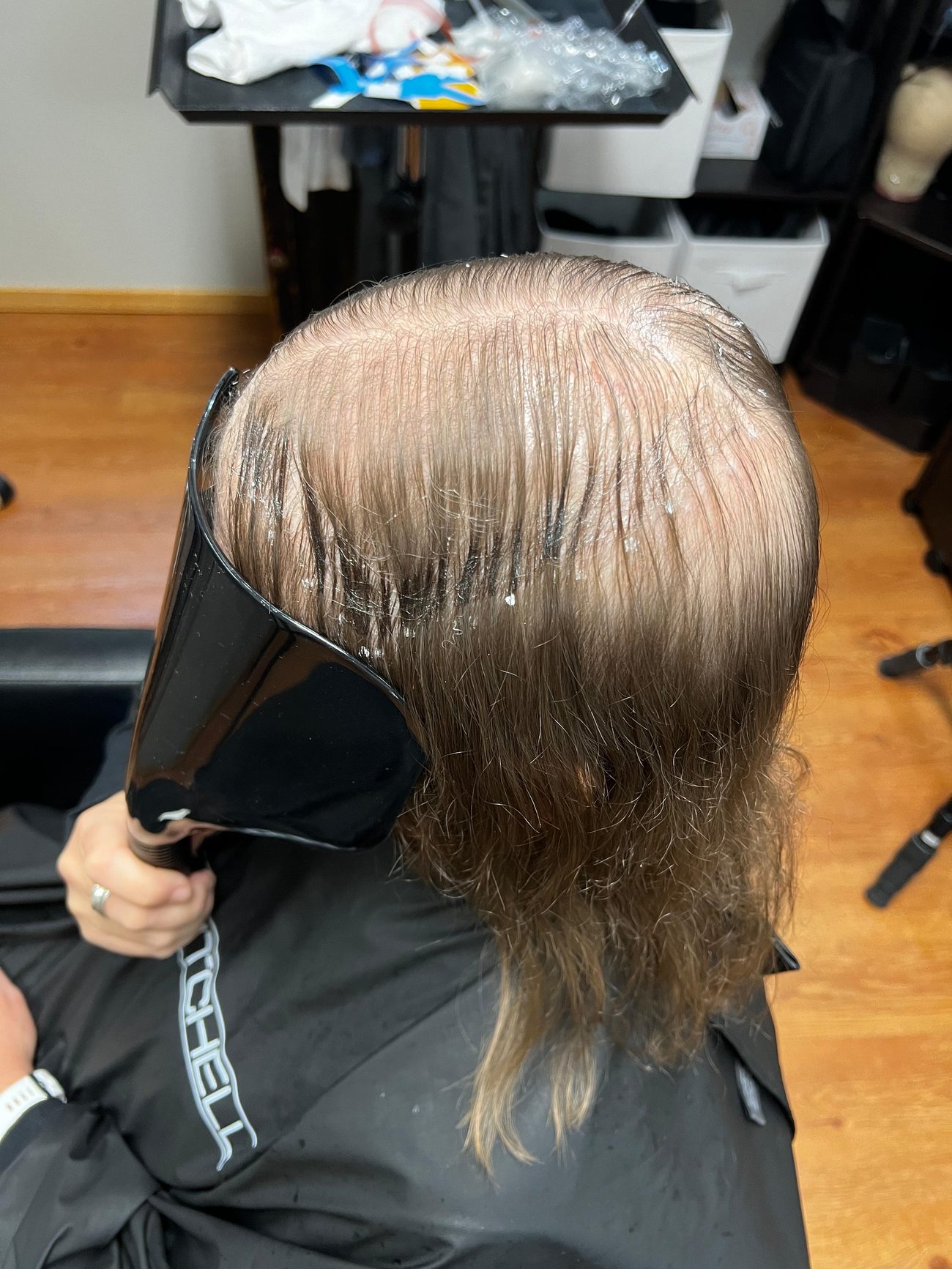A woman&rsquo;s diffuse crown thinning before a hair topper was fitted
